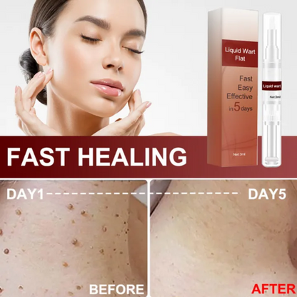 SkinClean™ Clear Skin WITHOUT SURGERY or Scars!
