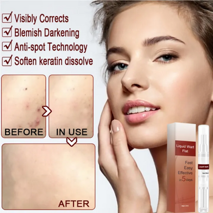 SkinClean™ Clear Skin WITHOUT SURGERY or Scars!