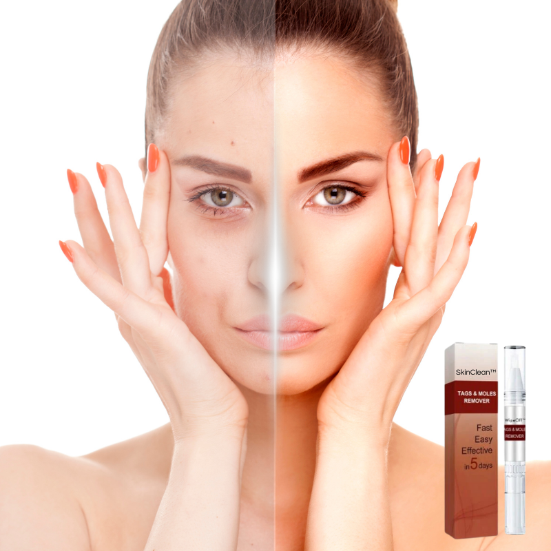 SkinClean™ Clear Skin WITHOUT SURGERY or Scars!