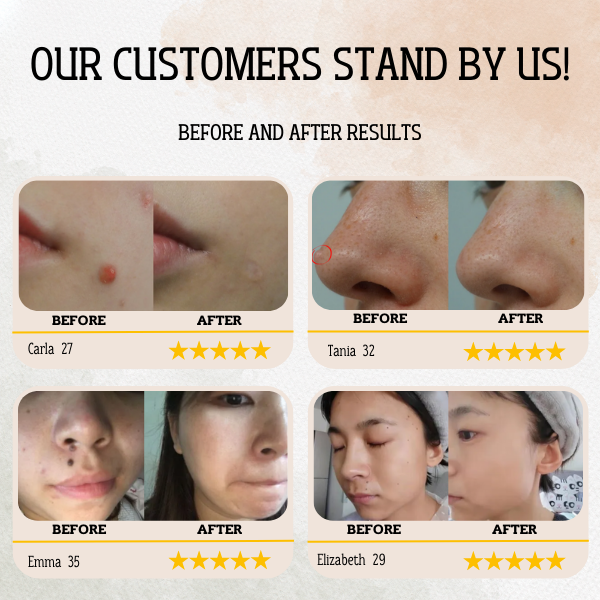 SkinClean - Tags & Moles Remover